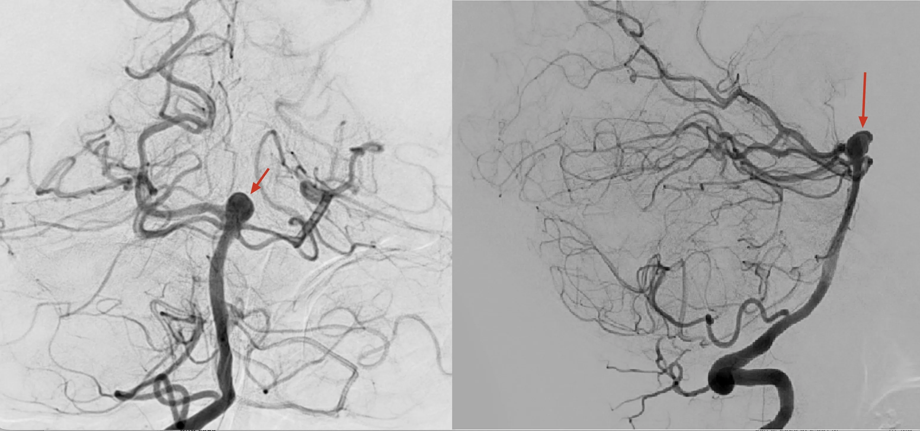 Two cerebral angiography views with red arrows pointing to an aneurysm
