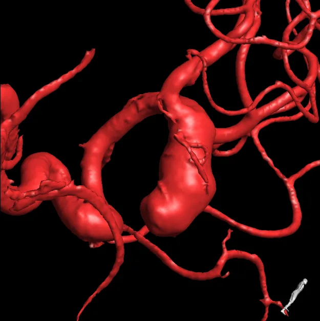 Red three-dimensional angiographic reconstruction showing an aneurysm and surrounding arteries