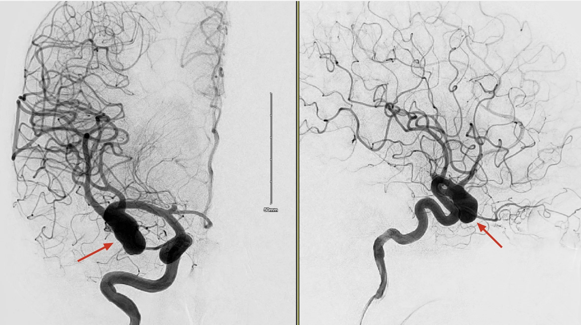 Two additional cerebral angiography views with red arrows marking an aneurysm