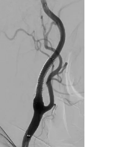 Carotid angiogram after stenting showing improved vessel opening and blood flow