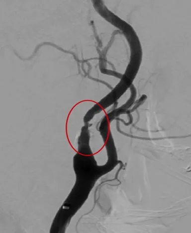 Carotid angiogram before stenting with a red circle marking severe narrowing near the carotid bifurcation