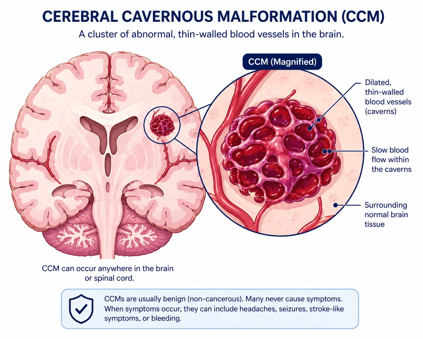 Illustration of a cerebral cavernous malformation as a cluster of thin-walled blood vessel spaces in the brain