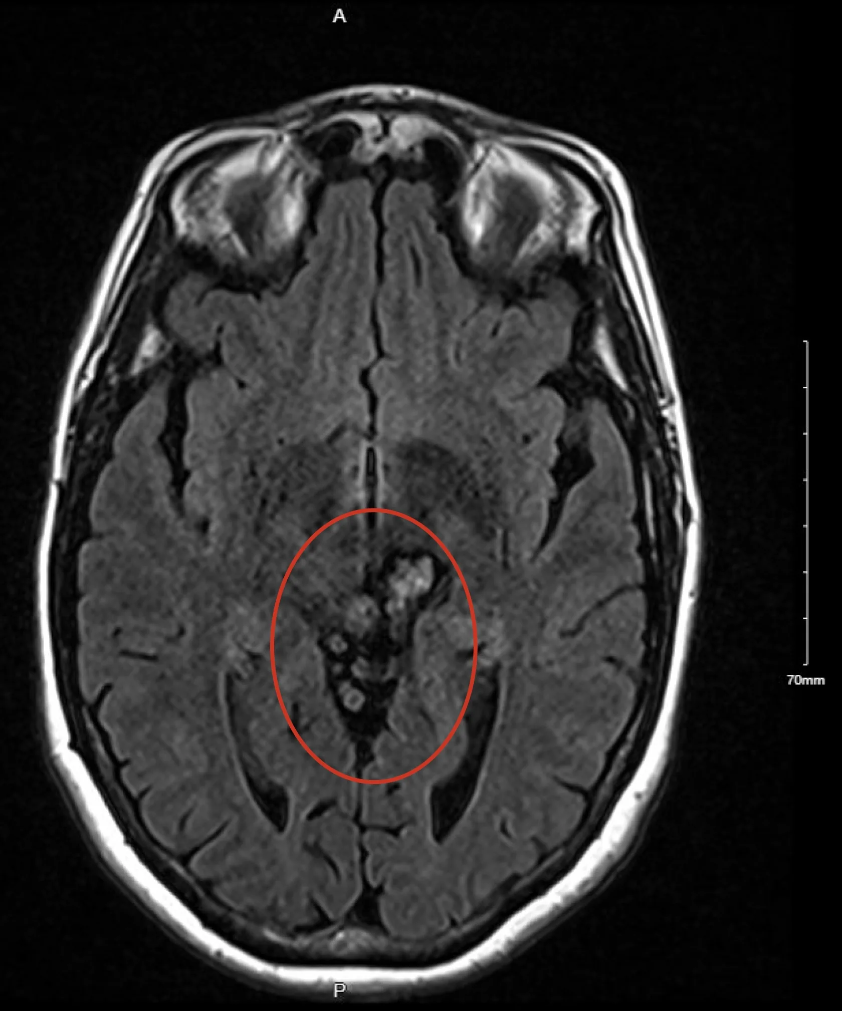 Axial MRI scan showing a cavernous malformation as a dark cluster near the center of the brain