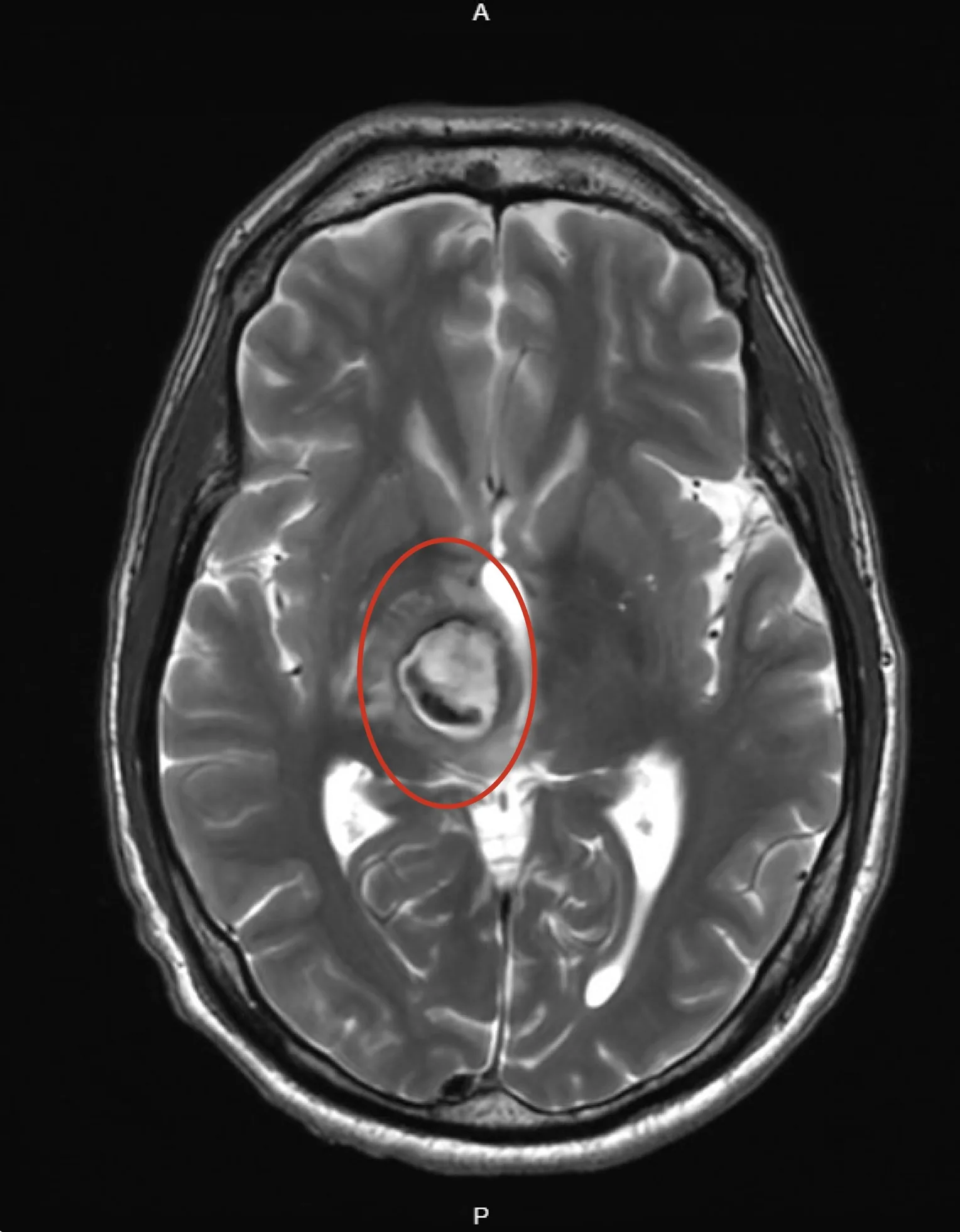 MRI scan showing a cavernous malformation as a mixed bright and dark spot surrounded by a dark hemosiderin rim