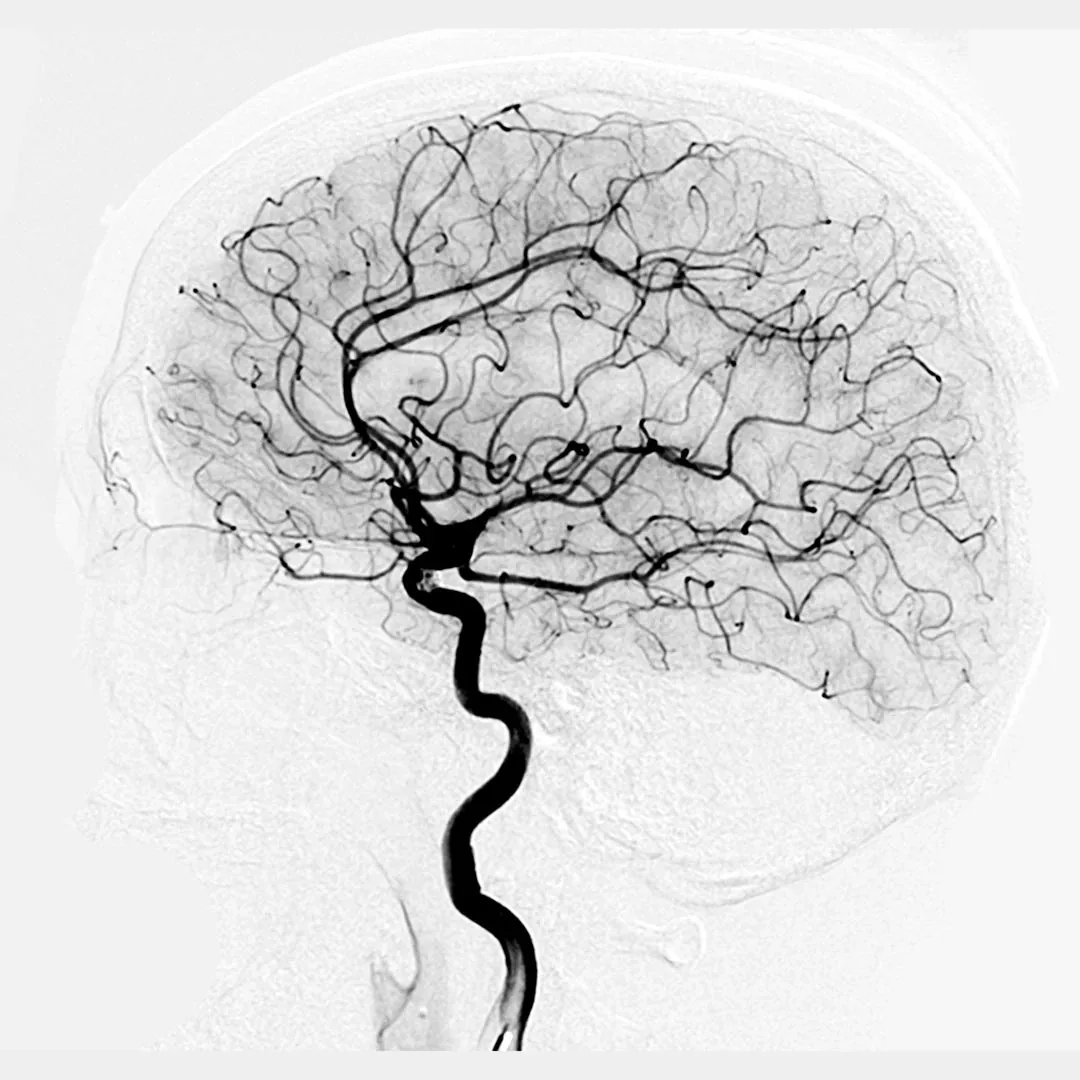 Cerebral angiogram showing intracranial vasculature