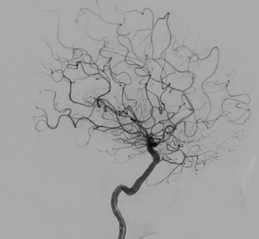 Cerebral angiogram after intracranial stenting showing improved blood flow in the treated artery