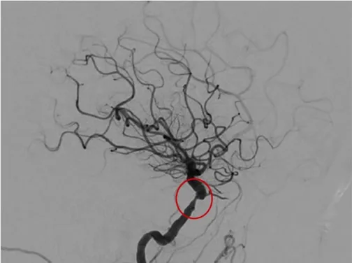 Cerebral angiogram before intracranial stenting with a red circle marking narrowed blood flow in an artery inside the skull