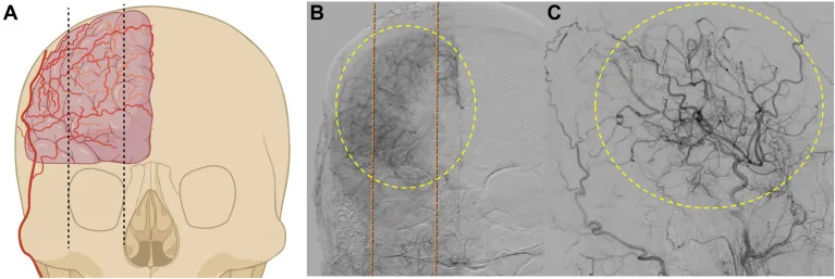 Angiogram with dashed yellow circles marking collateral vessels from scalp and meningeal arteries crossing into middle and anterior cerebral artery territory