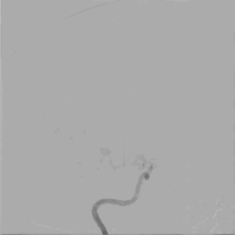 Lateral angiography animation showing contrast moving through narrowed right internal carotid artery vessels in Moyamoya disease