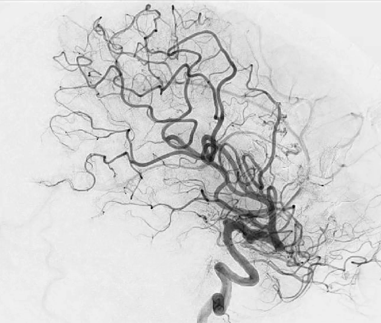 Post-treatment lateral angiographic view after surgical resection and stereotactic radiosurgery