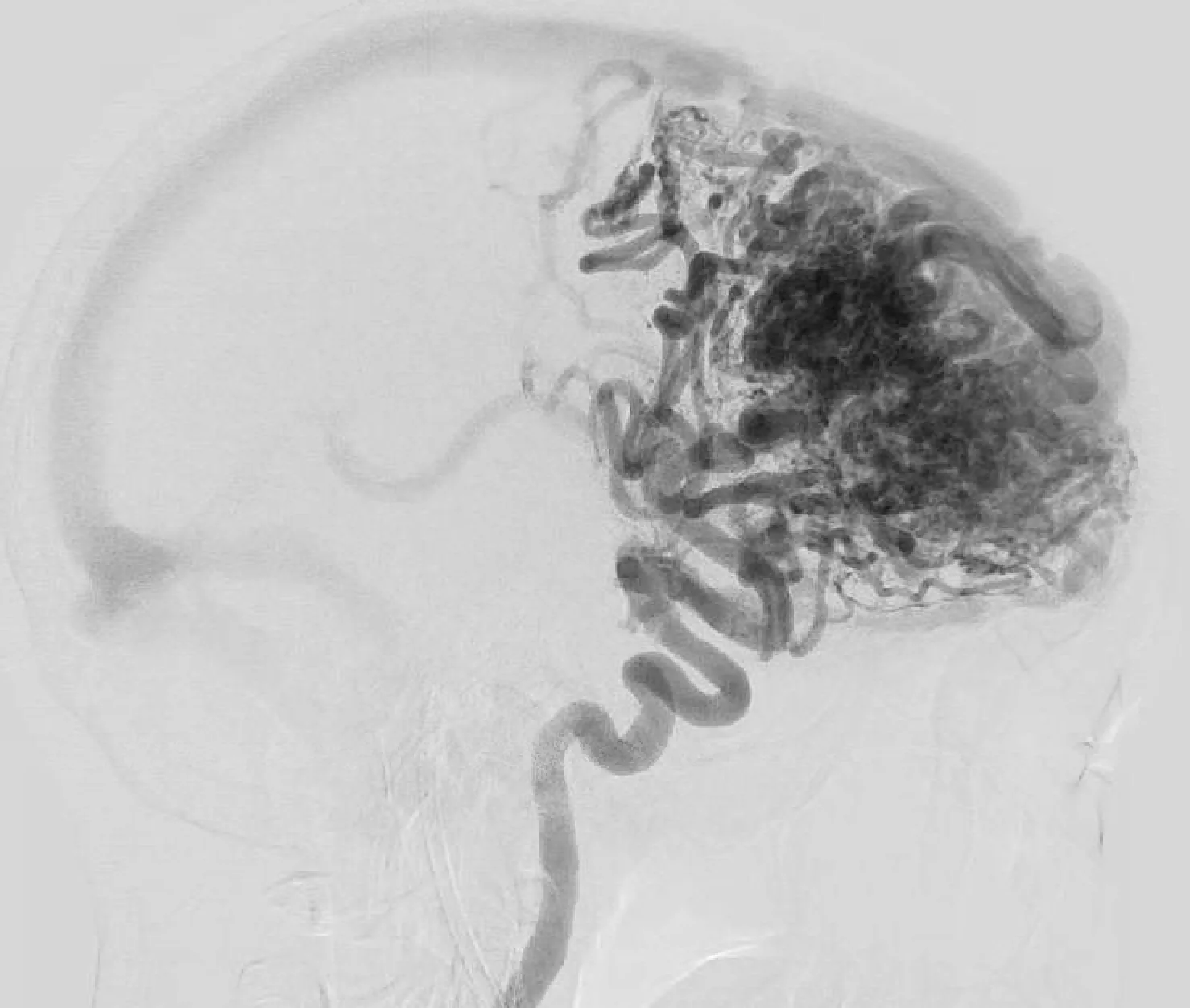 Pre-treatment lateral angiographic view of an arteriovenous malformation