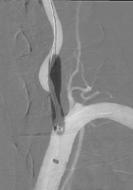 Vertebral artery angioplasty image showing balloon treatment of the narrowed segment