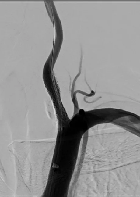 Vertebral artery angiogram after stenting showing improved blood flow through the vessel