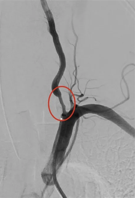 Vertebral artery angiogram before treatment with a red circle marking severe narrowing at the artery origin
